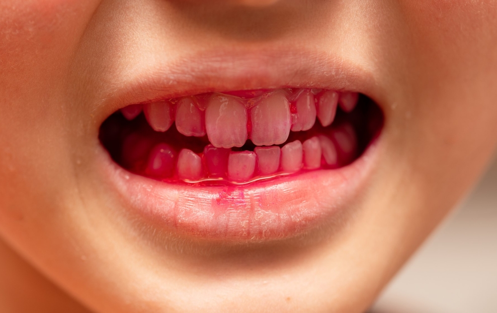 ② プラークの染め出し