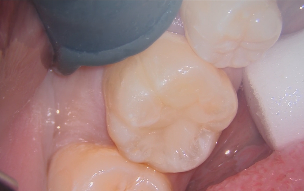 9.おおよその充填が完了した状態です。形が整ってきた段階で、噛み合わせや周囲との調和を確認します。