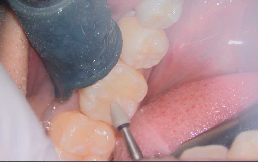 10.噛み合わせを調整し、形態修正と研磨を行って仕上げます。最後に細かい部分を整え、滑らかになるよう研磨して治療完了です。