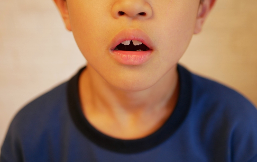 顎顔面矯正を検討することが多いケース